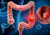 Primele semne ale cancerului de colon. Mulți oameni le ignoră până este prea târziu